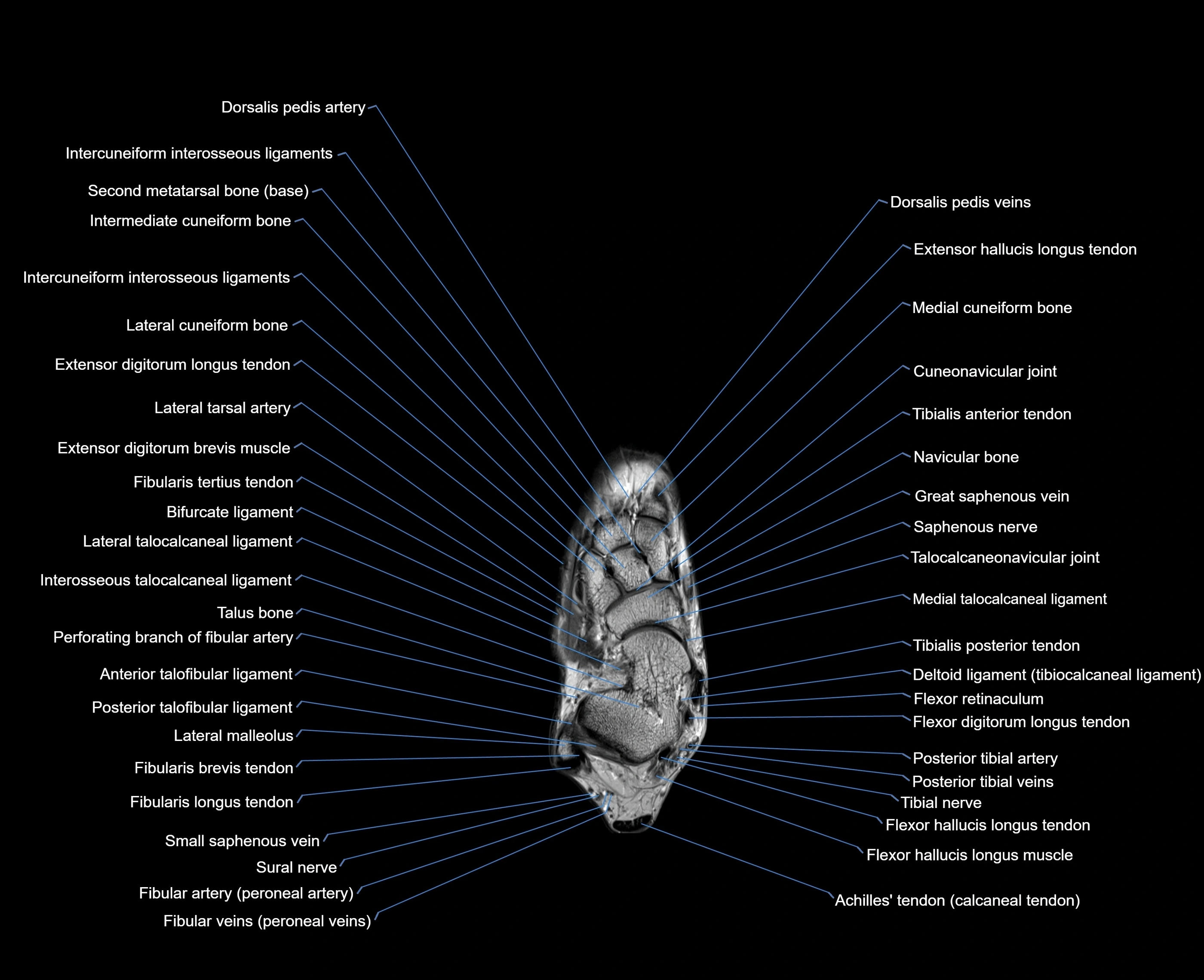 MRI foot coronal cross sectional anatomy 3T  radiology  image-img-00001-00013.webp